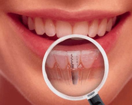 Clínica Dental José Mª Valdivieso mujer con implantes dentales
