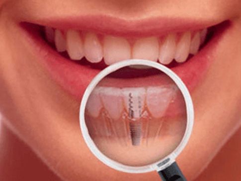 Clínica Dental José Mª Valdivieso mujer con implantes dentales