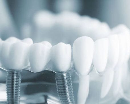 Clínica Dental José Mª Valdivieso implantes para dientes