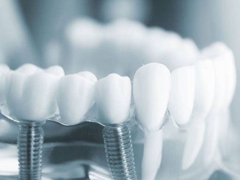 Clínica Dental José Mª Valdivieso implantes para dientes